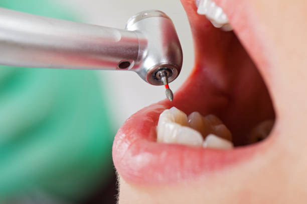 Best Emergency Wisdom Teeth Removal in New Market, TN